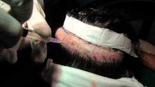 preview picture of video 'Female Hair Transplant Surgery in India, Bangalore'