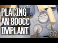 Placing A Large 800cc Breast Implant Uncensored Surgery Footage Brown Plastic Surgery