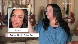 HOW TO TREAT STUBBORN MELASMA AT HOME WITH MUSELY'S THE SPOT CREAM | Prescription Treatment