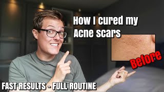 HOW TO GET RID OF ACNE SCARS FAST |  Skincare routine for acne scarred skin