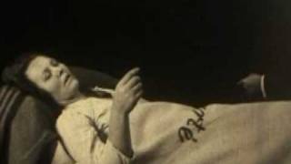 Acute Encephalitis Lethargica (1925)