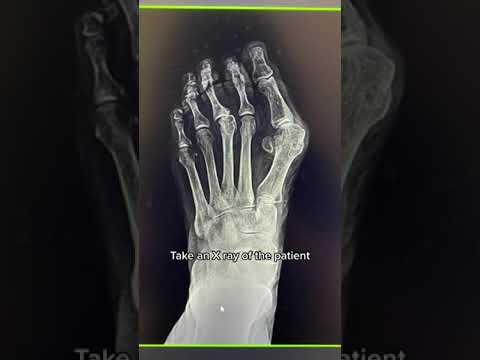 Can THIS Get Rid of YOUR Bunions?