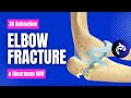 Elbow (Olecranon) Fracture and Fixation - 3D Animation