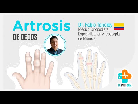 Artrosis de dedos | Tu Salud Guía