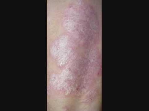 Tudósok találtak gyógyírt a pikkelysömörre, psoriasis Leírás