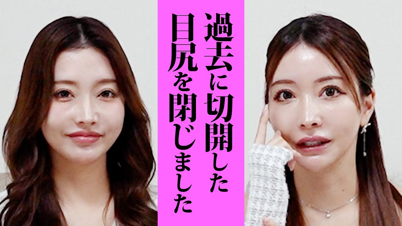 【やり直せる】過去に開いた目尻を今の自分に合わせて再調整してきました【目尻整形】