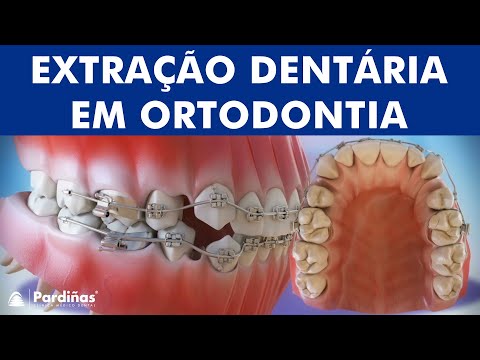 Extração do dente em ortodontia ©