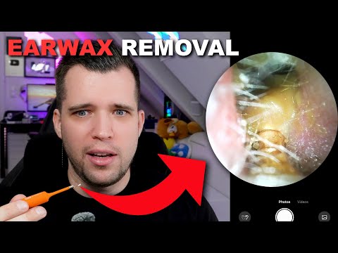 Earwax Removal - The Best Ear Cleaning - Bebird EarSight Ultra X