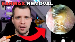 Earwax Removal - The Best Ear Cleaning - Bebird EarSight Ultra X