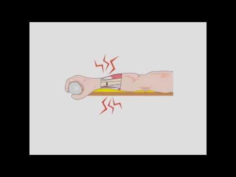  FASPLINT® Semi-disposable Vacuum Splint Demonstration