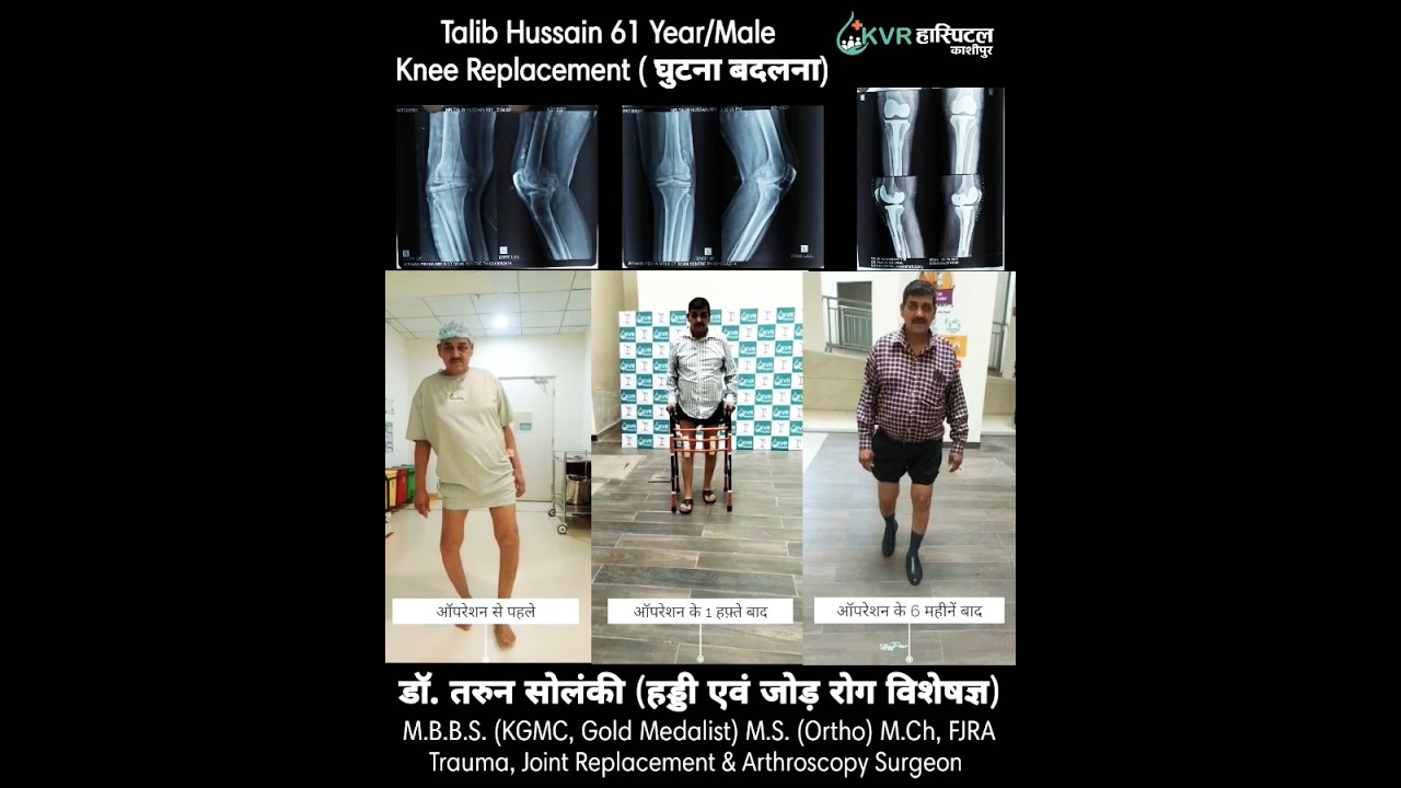 Knee Replacement- Talib Hussain(61 Year/Male)