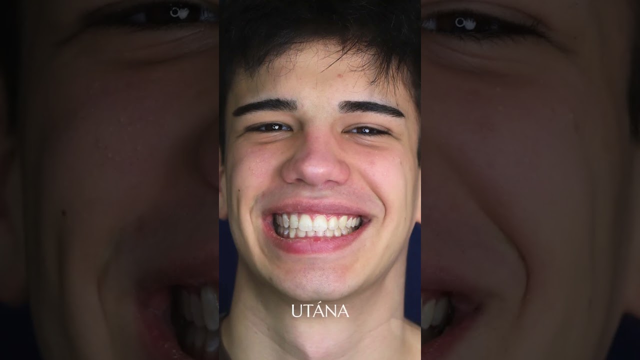 🦷" Feketeöves fogszabályozás" - Dénes visszajelzése / Dr. Kovács Sarolta fogaszabályozó specialista