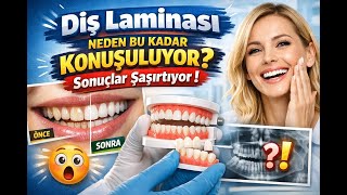 Diş Laminasi Neden Bu Kadar Konuşuluyor? Sonuçlar Şaşırtıyor