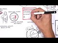 Chronic Pancreatitis Overview
