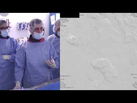 LEFT SFA CTO REVASCULARIZATION