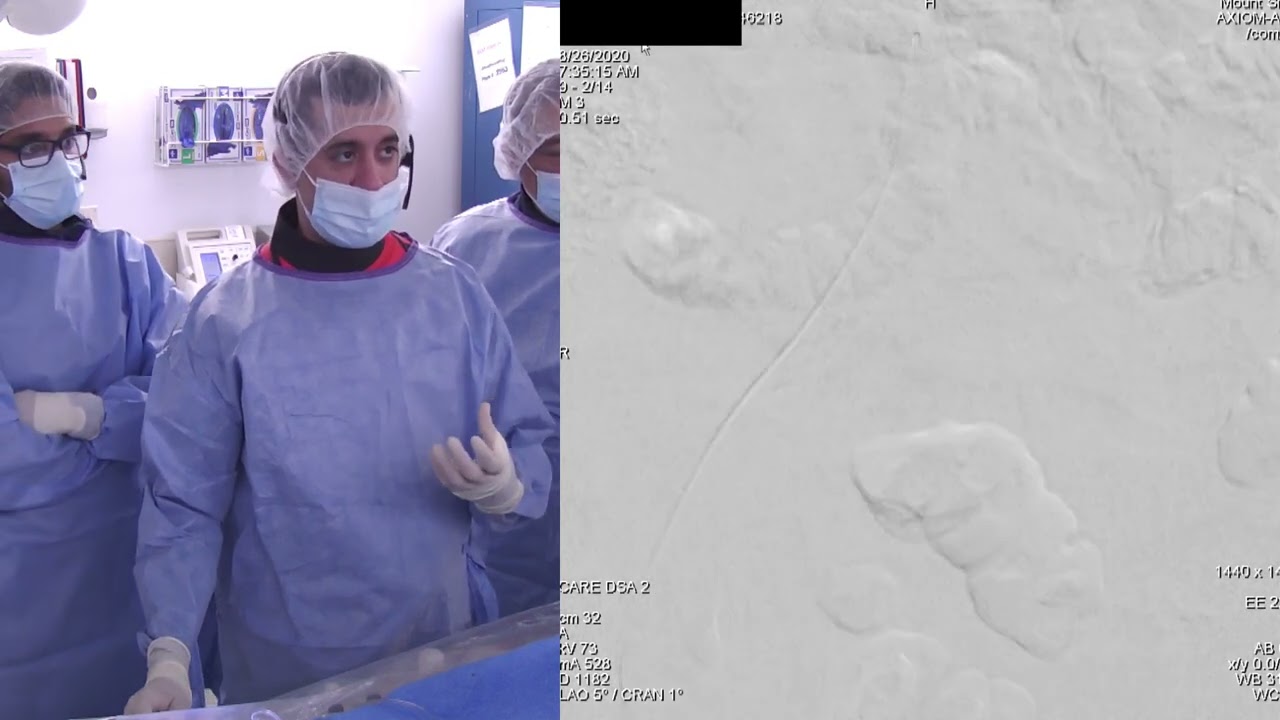 LEFT SFA CTO REVASCULARIZATION