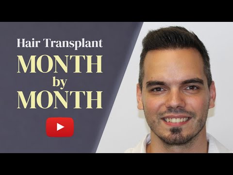 Here's How Your Hair Will Grow After Hair Transplant!...