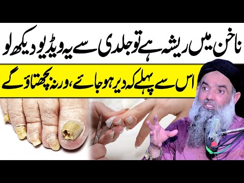 ناخن میں ریشہ ہے تو جلدی سے یہ ویڈیو دیکھ لو || Nails Infection Treatment || Dr Sharafat Ali