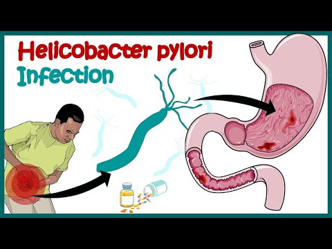 , title : 'Helicobacter Pylori Infection | Gastric ulcer | Causes, Signs and Symptoms, Diagnosis and Treatment.'