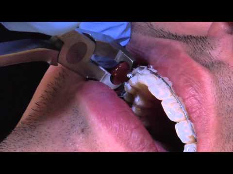 Zdejmowanie aparatu ortodontycznego. Część 2.