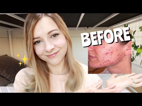 How I Keep my Skin Acne Free (+ Make it Less Oily)