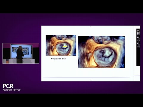 Advancing valve repair: mastering diverse mitral and TR anatomies with the PASCAL Precision system