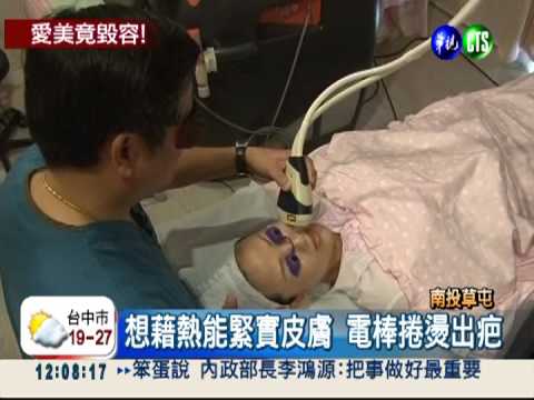 用電棒捲護膚?! 異想天開燙傷臉