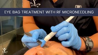 Non-Surgical Solution for Eye Bags | Agnes RF with Dr. T