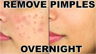 How To Remove Pimples Overnight | Acne Treatment | ShrutiArjunAnand