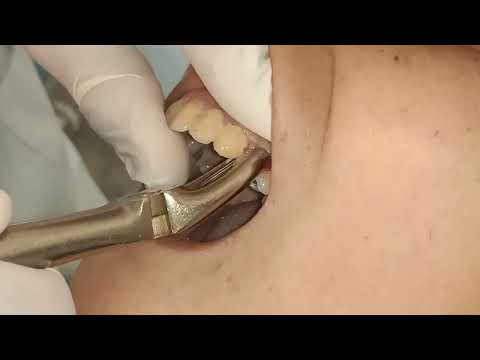 Exodontia Badly Decayed Upper Premolar.