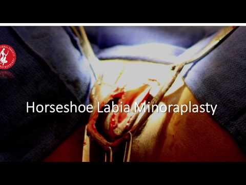 download lagu mp3 mp4 Capuchon Clitoris, download lagu Capuchon Clitoris gratis, unduh video klip Capuchon Clitoris