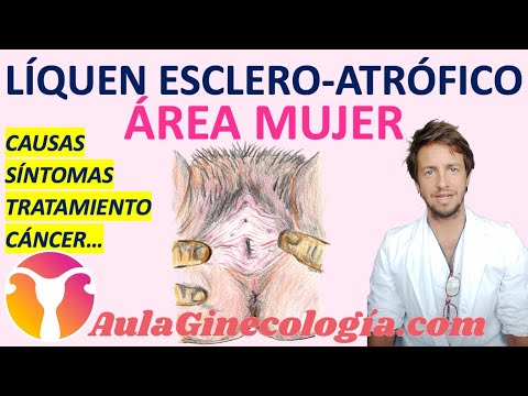 Lichen sclerosus: Cause, symptoms, treatment, cancer risk... Gynecology and Obstetrics