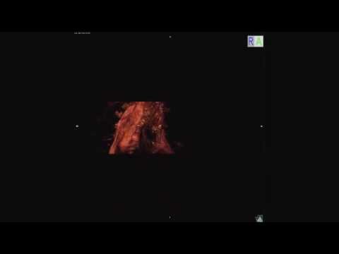 Atherosclerosis in the ancient world Video 1: 1/2