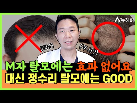 정수리 탈모치료 효과 보는 방법 알려드립니다ㅣ뉴헤어