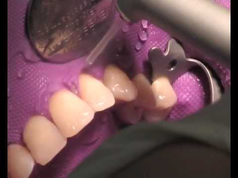 Hard Tissue Application of Er:YAG dental laser | Dr. Rositsa Koleva