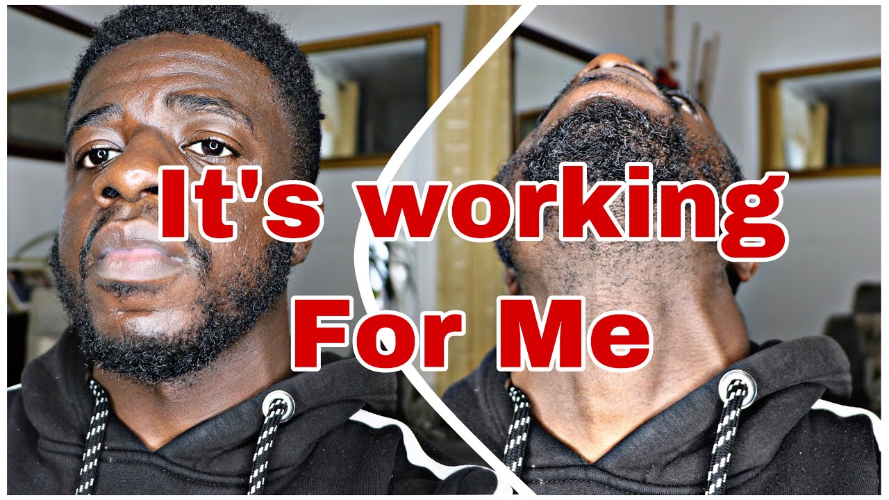 My Minoxidil Daily Routine ( This is why it’s working for me )