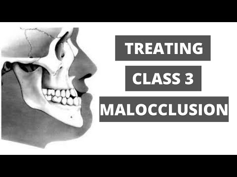 Management of Class 3 Malocclusion -Orthodontics