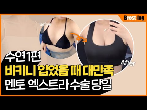 가슴성형 브이로그 1편 | A컵에서 꽉찬 풀C컵 후기 | 멘토 엑스트라 스무스 | 윈느성형외과 라벨윈느 유튜브 영상