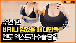 隆胸 Vlog 第1集 — Mentor Xtra Smooth 假体恢复记录 | UNE 整形外科 — La Belle Une 视频频道