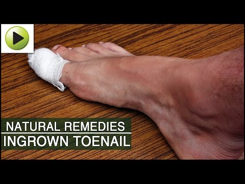 Ekzoderil fungus review at presyo Fungus foot bath salt