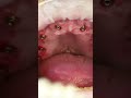 Dental implant’s All on X in Prague Total reconstruction #shorts #dentist #dental #implant #veneers