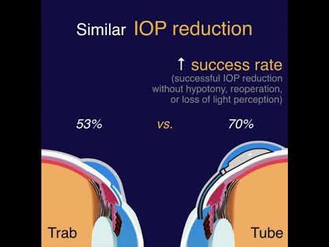 TVT - Tube vs Trab Study