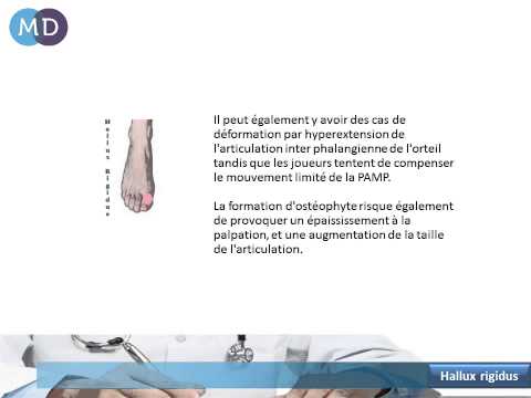 comment soulager l'arthrose du gros orteil