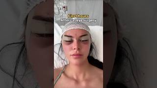 Download lagu Cat Eye Surgery ✨ | Stunning Before & After Transformation mp3