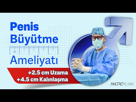 Penis Büyütme Ameliyatı (+2.5 cm uzama, +4.5 cm kalınlaşma) Op. Dr. Evren IŞIK