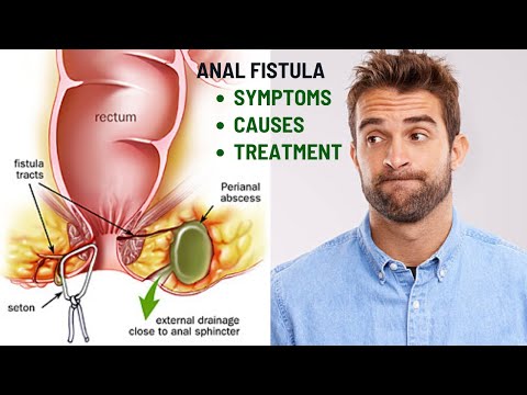 Pain, Discharge, and Swelling from Anal Fistulas? Get Expert Treatment with Dr. Shiraz Farooq