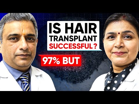 Ultimate Hair Transplant Guide: Hair Loss, What to Expect, Side Effects & Cost? | Hair Surgeon React