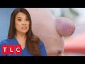 Patient Has a Huge Knob on His Forehead | Dr. Pimple Popper