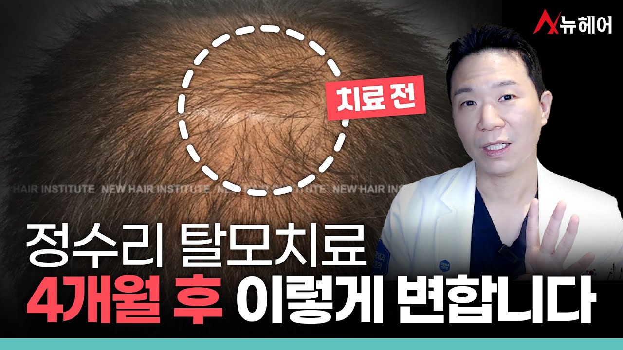 정수리 탈모치료 효과는 '이 치료'로 볼 수 있습니다ㅣ뉴헤어
