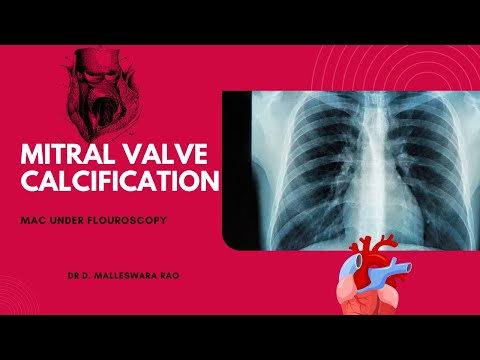 MITRAL VALVE CALCIFICATION | MAC | Dr D. Malleswara Rao